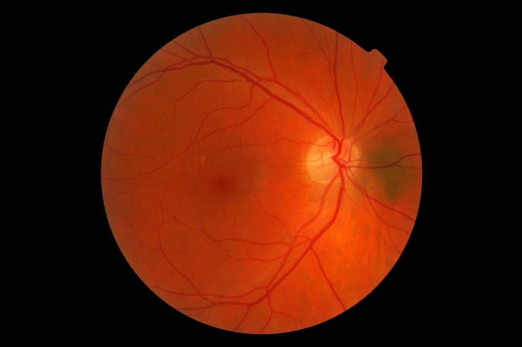 Retinascan
